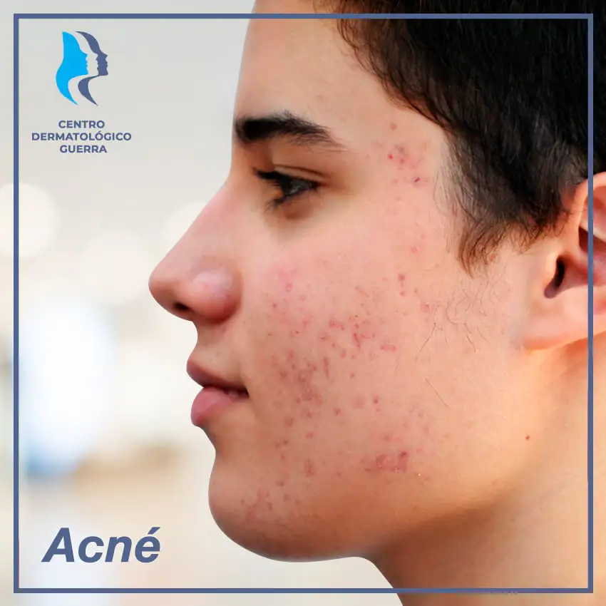 acne en monterrey