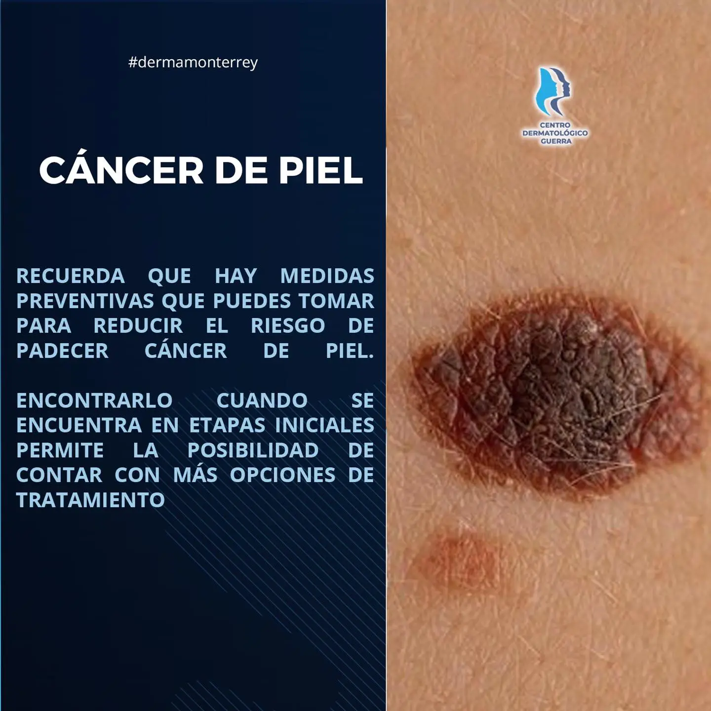 cancer de piel en monterrey