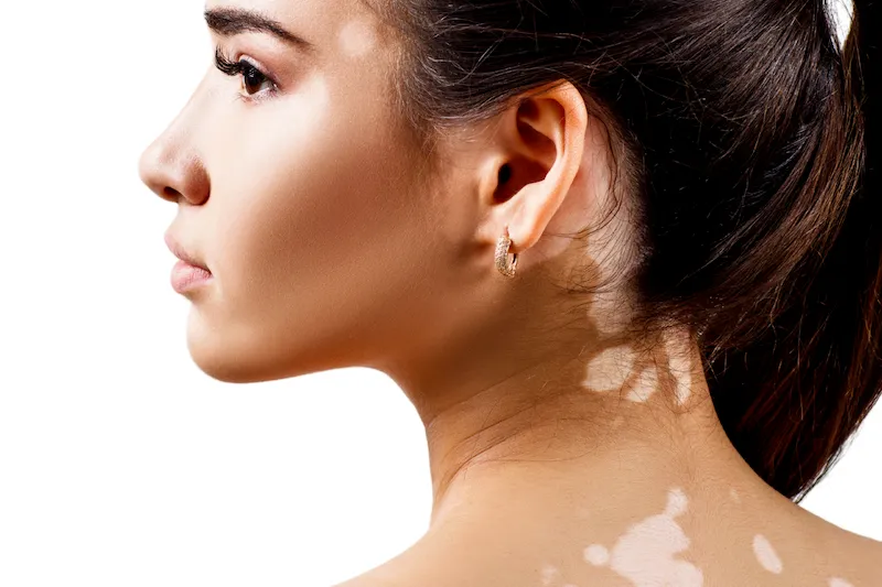 especialista en vitiligo en monterrey